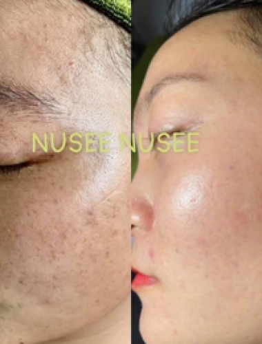 Sau khi sử dụng mộc mỹ nhân nusee