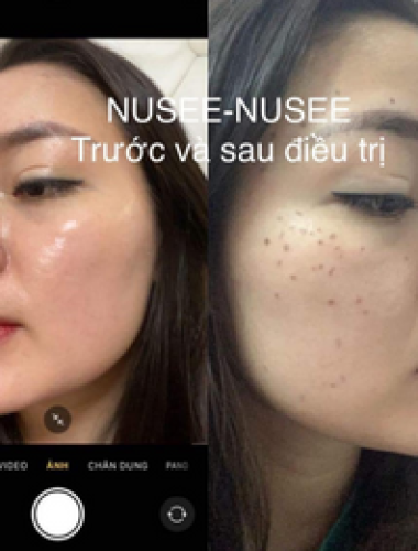 Trước và sau khi sử dụng